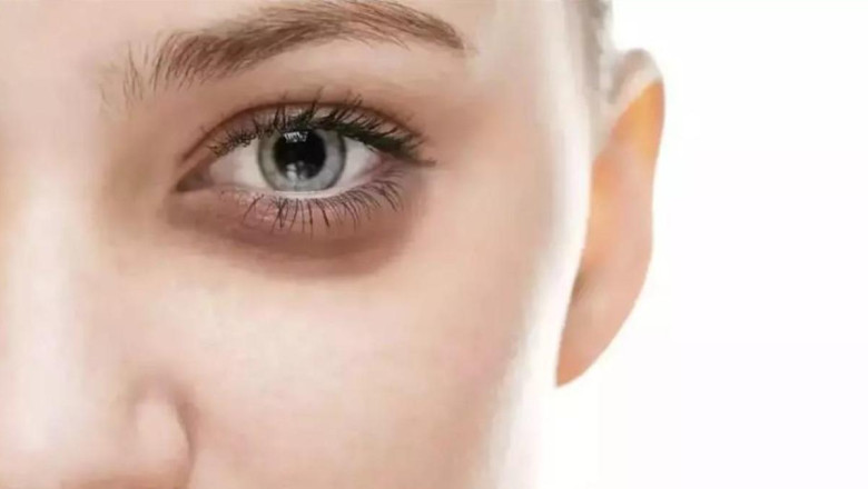 GÖZ ÇEVRESİNDE YAŞLANMANIN ÖNLENMESİ İÇİN NELER YAPILABİLİR?