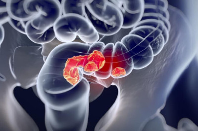 Mart Ayı Kolorektal Kanser Farkındalık Ayı: Ücretsiz Tarama Hayat Kurtarıyor