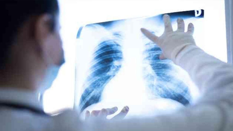 Akciğer Kanserine Dikkat: BİKAMDER’den Bilgilendirici Kahvaltı