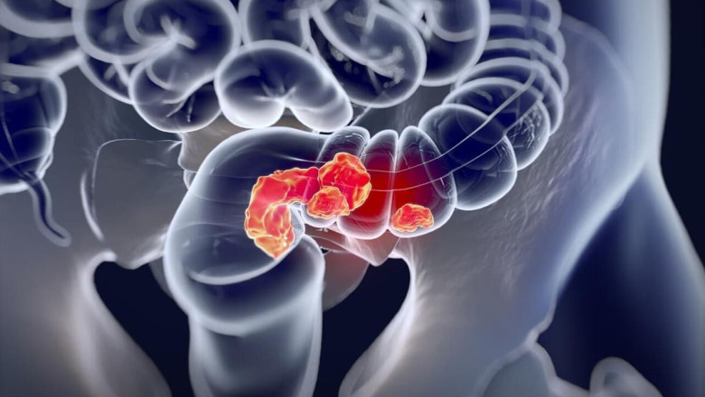 Mart Ayı Kolorektal Kanser Farkındalık Ayı: Ücretsiz Tarama Hayat Kurtarıyor